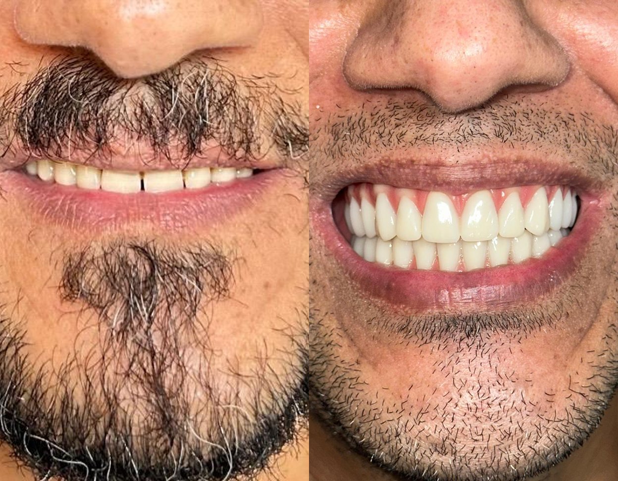 resultado 4